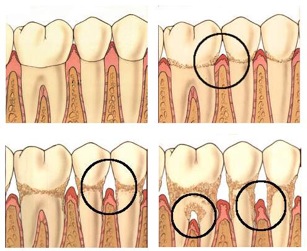 enfermedad periodental 1