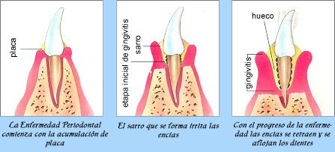 enfermedad periodental 2
